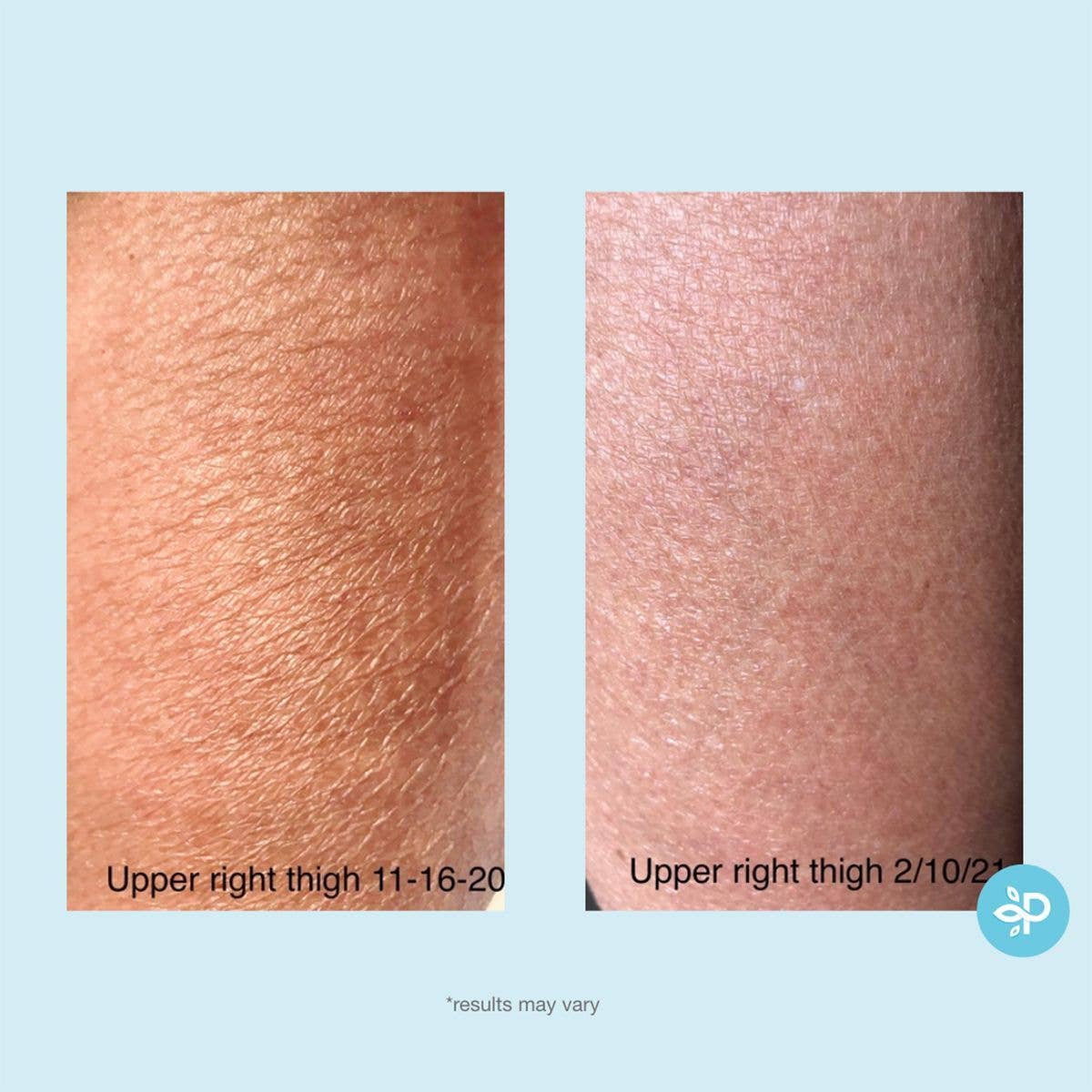Perfect Image - Gly + Sal Exfoliating Body Lotion
